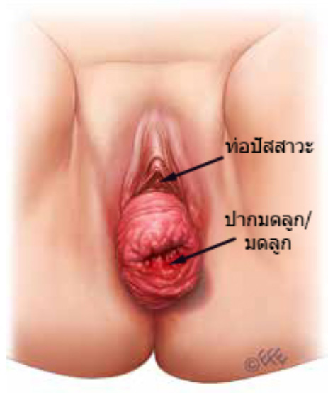 รูปที่ 1 มดลูกยื่นย้อย ก่อนผ่าตัด